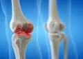 Osteoartrita genunchiului poate fi influențată prin stilul de viață