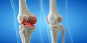 Osteoartrita genunchiului poate fi influențată prin stilul de viață