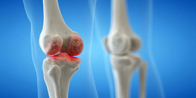 Osteoartrita genunchiului poate fi influențată prin stilul de viață